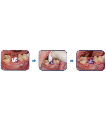 KIT PERIACRYL 10 MONODOSIS